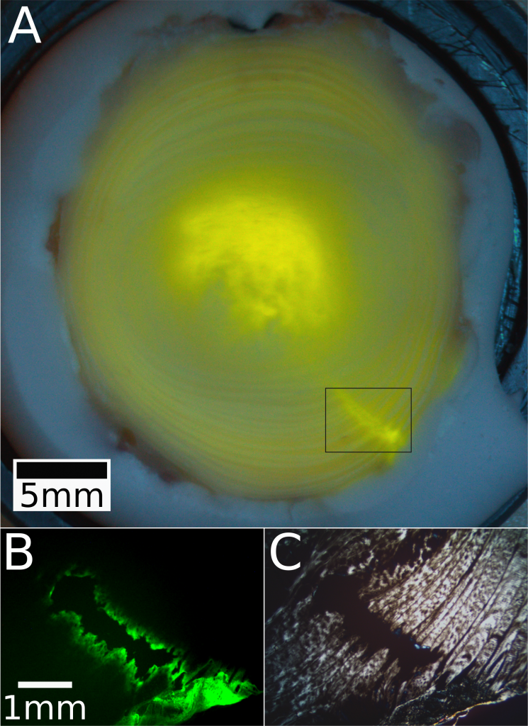 A representation of intradiscal injection